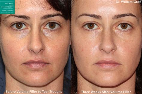 The Many Uses Of Juvederm