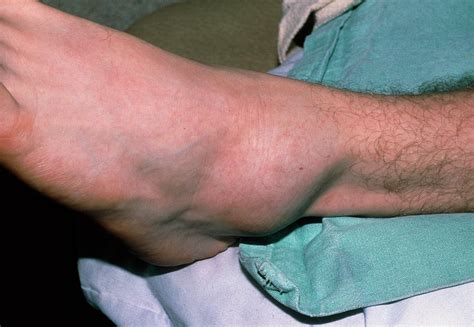 Swollen Left Ankle Due To Sprain Photograph By Science Photo Library