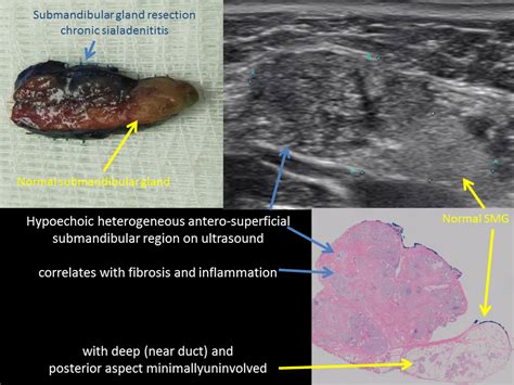 Swollen Submandibular Gland Ultrasound