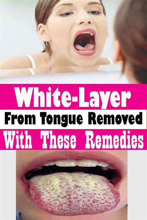 White Layer From Tongue Removed With These Remedies In 2020 Healthy