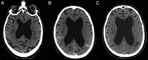 A Diagnosis Of Haemolytic Uraemic Syndrome Blurred By Alcohol Abuse