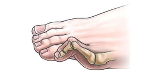Hammer Toe Symptoms Causes Treatment And Rehabilitation