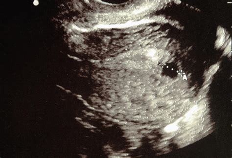 6 weeks pregnant and the changes in your growing baby (and your body) continue big time. 6 Weeks Pregnant Ultrasound