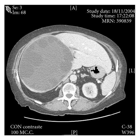 Preoperative Abdominal Ct Massive Liver Hydatid Cyst Replacing