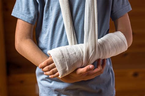 Arm Cast Pictures Images And Stock Photos Istock