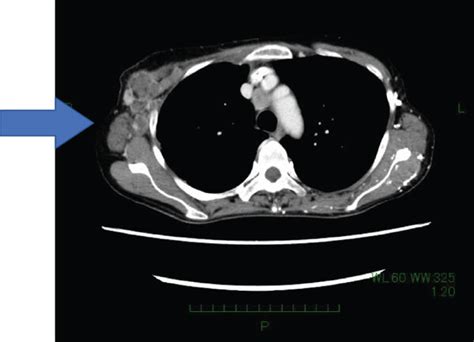 A Ct Scan Section Showing Right Axillary Lymph Nodes Before