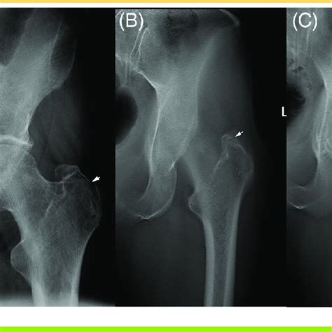 Base Of Greater Trochanter Fracture Confirmed On Dts A 66 Year Old