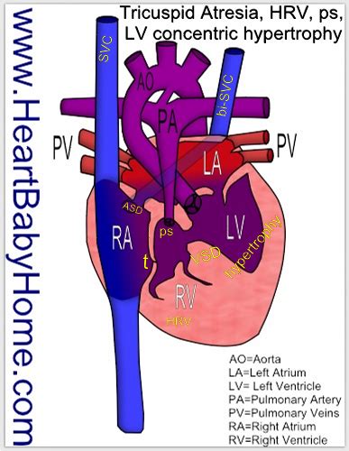 Cardiac Anatomy Congenital Heart Defect Hrv Travel Nursing