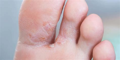 Athlete S Foot Tinea Pedis Benenati Foot And Ankle Care Centers