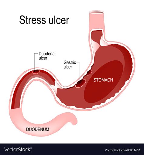 Peptic Ulcer Disease Royalty Free Vector Image