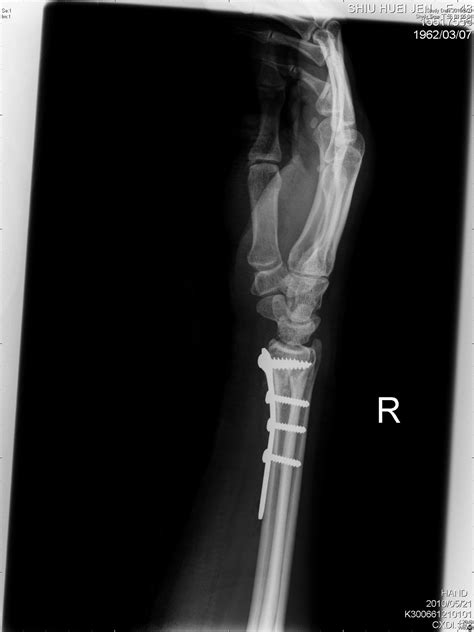 Big Bad: Distal radius fracture with acute scapholunate ...