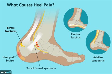 Heel Pain Causes Treatment And When To See A Healthcare Provider
