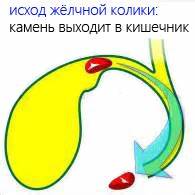 Диета при желчная колика Желчная колика: симптомы, причины желчной колики, методы лечения и Желчная колика: симптомы, причины желчной колики, методы лечения и Диета при желчная колика