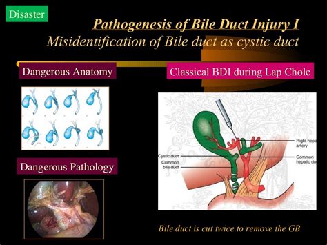 Bile Duct Injury During Laparoscopic Cholecystectomy