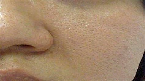Home Remedies For Open Pores How To Close Open Pores How To Reduce