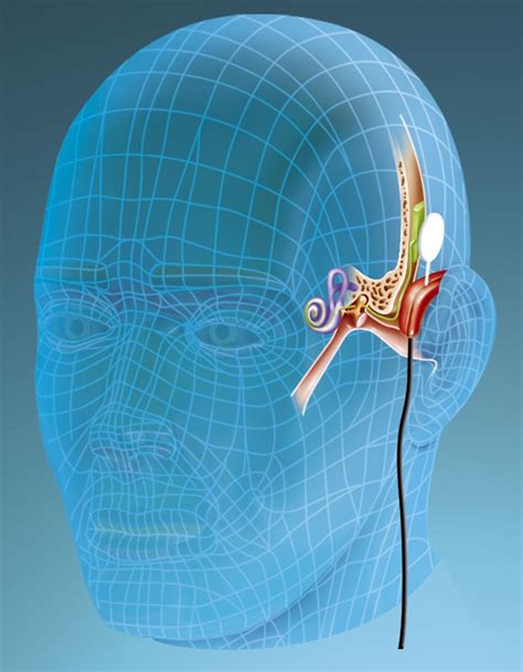Consensus Study Says Cochlear Implants Can Help People With Severe
