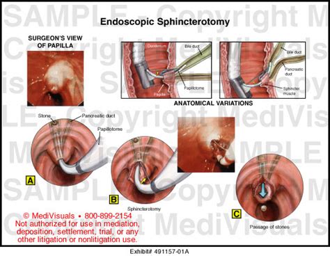 Endoscopic Sphincterotomy Medical Exhibit Medivisuals