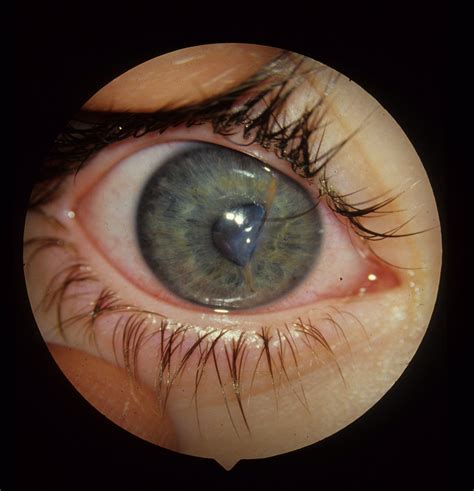 Ocular Laceration The Clinical Advisor