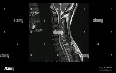 Magnetic Resonance Images Of Cervical Spine Sagittal T Weighted Images Mri Cervical Spine