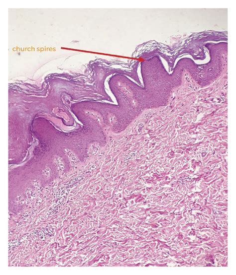 H E Stain With Focal Areas Of Hyperkeratosis Papillomatosis And