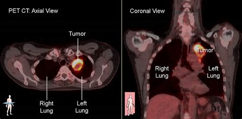 Lung Cancer Cat Scan