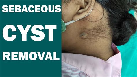Sebaceous Cyst Removal Surgery Under Local Anesthesia Dr Prashant