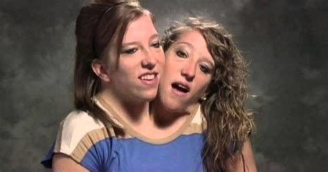 10 Interesting Stories Of Conjoined Twins Listverse