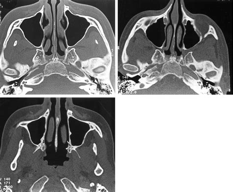 Granular Cell Tumor Of The Palate A Case Report American Journal Of