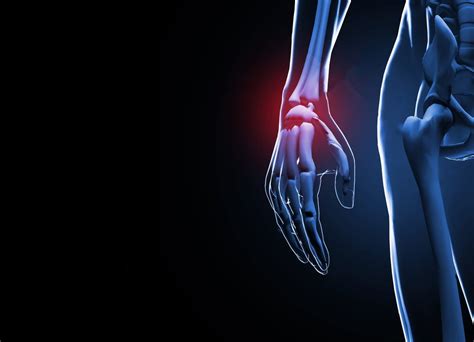 Physical Therapist's Guide to Wrist Tendinitis
