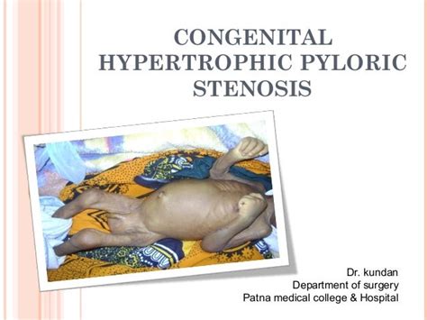 Congenital Hypertrophic Pyloric Stenosis