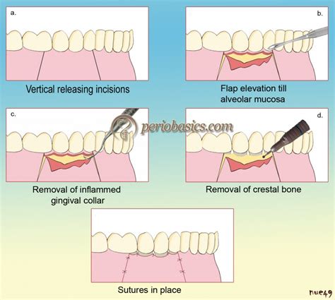 History Of Surgical Periodontal Pocket Therapy And Osseous Resective