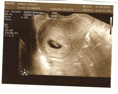 Irwin With An I 6 Week Ultrasounds