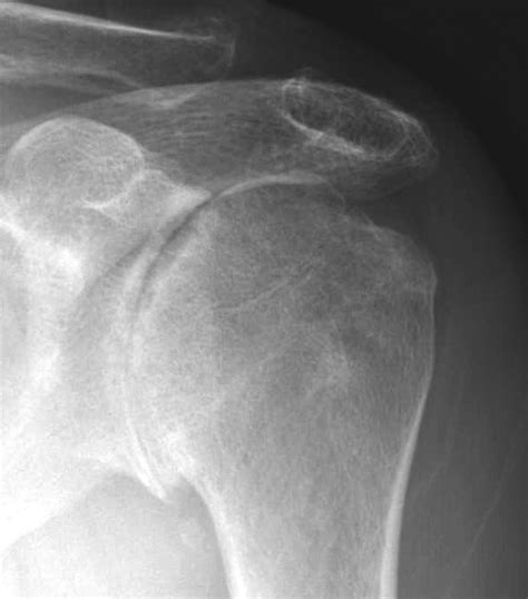 Discover natural support strategies to help ra. Shoulder Arthritis / Rotator Cuff Tears: causes of ...