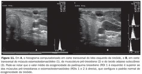Radiologia Brasileira Importância da ecogenicidade da tireóide no