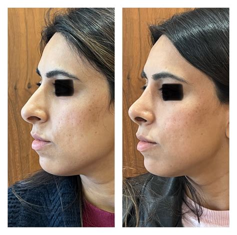 Septorhinoplasty Nose Shape Correction Surgery London Ent
