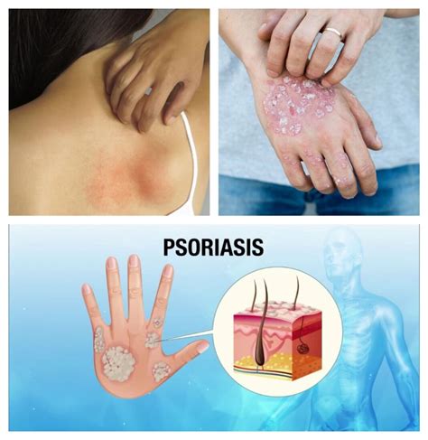 Tipos De Psoriasis Desde La Más Común A La Más Difícil De Tratar