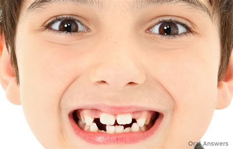 7 Year Old Front Teeth Not Coming Teethwalls