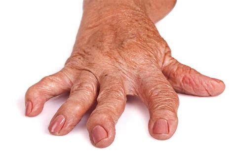Romatoid Artrit ve Rehabilitasyonu EKOL FİZYOTERAPİ