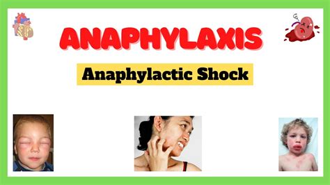 Anaphylactic Shock Anaphylaxis Signs And Symptoms Causes