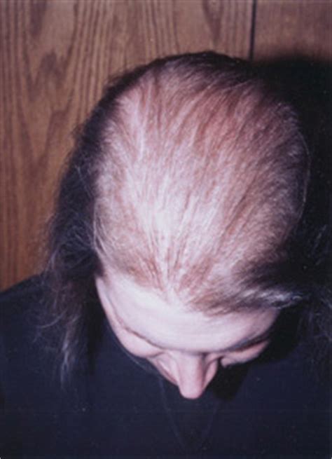 So many women experience hair loss but so few actually talk about it. Colorado Dermatology Center