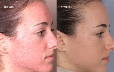 Silkpeelclarity Skin By Design Dermatology And Laser Center Pa