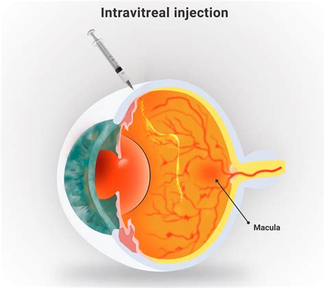 Eye Injections For Macular Degeneration Eye Injection Side Effects