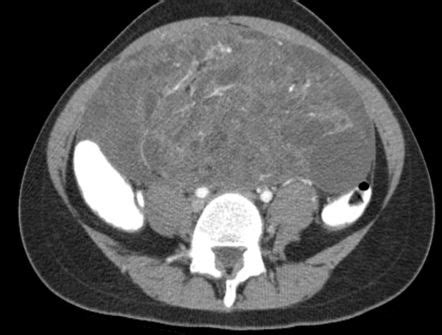 Immature Ovarian Teratoma Radiology Case Radiopaedia Org