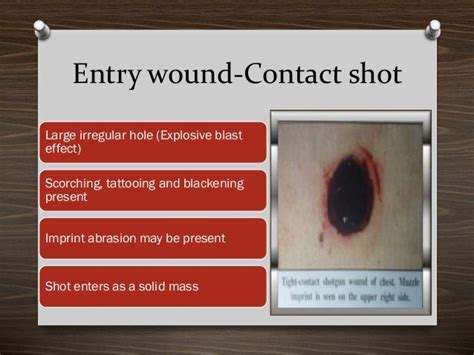Location Of Wounds In Self Inflicted Firearm Injuries