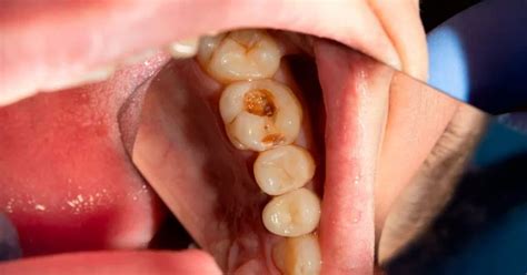 Caries Dental Tipos Y Tratamientos Clínica Dental Tacna