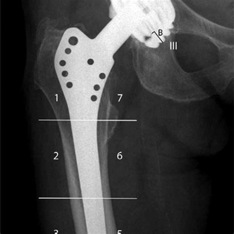 Frontal Radiograph With Gruen Femoral Zones 17 And De Lee Charnley