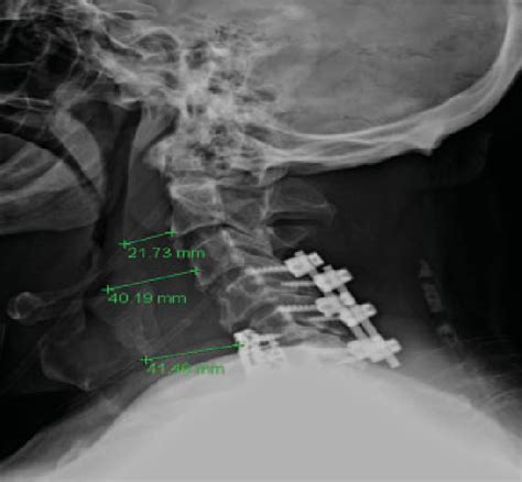Soft Tissue Edema Following Anterior Cervical Discectomy And Fusion