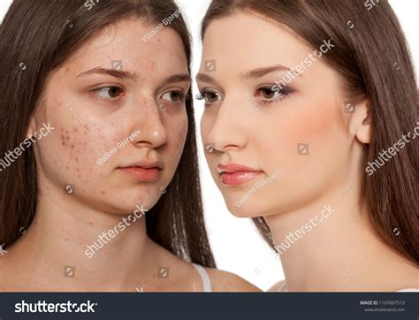 Comarision Portratit Teenage Girl Problematic Skin Stock Photo Edit