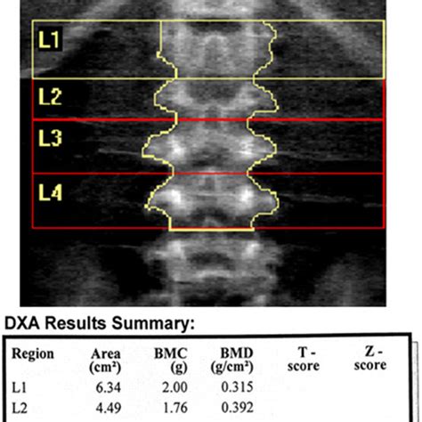 Lumbar Spine And Lateral Distal Femur Bone Mineral Density Z Scores In