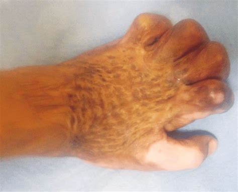 Ab Pre Operative Post Burn Contracture Deformity Of The Left Hand Download Scientific